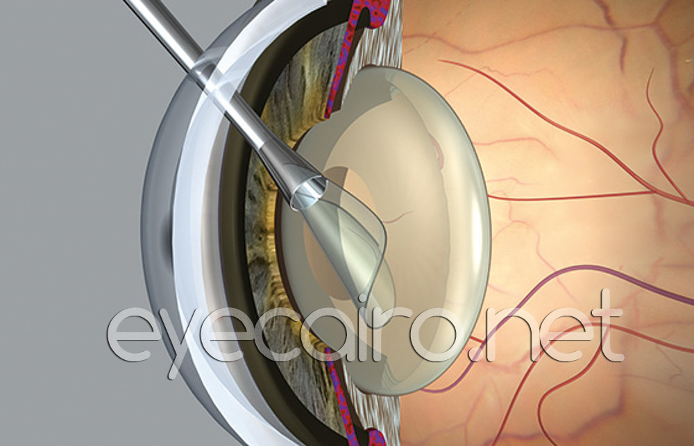 cataract-removal-lens-t