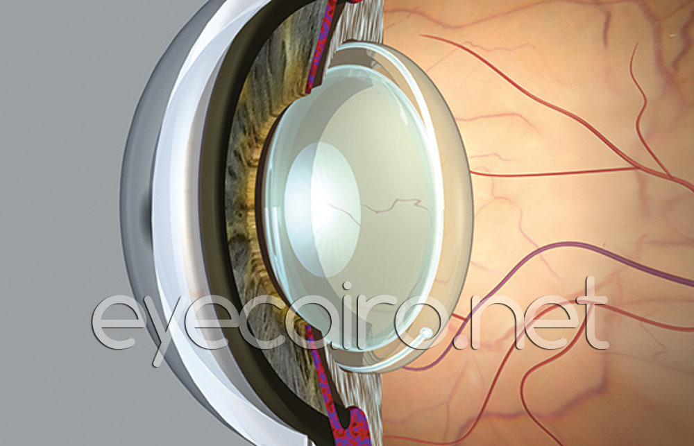 cataract-removal-lens2t-1