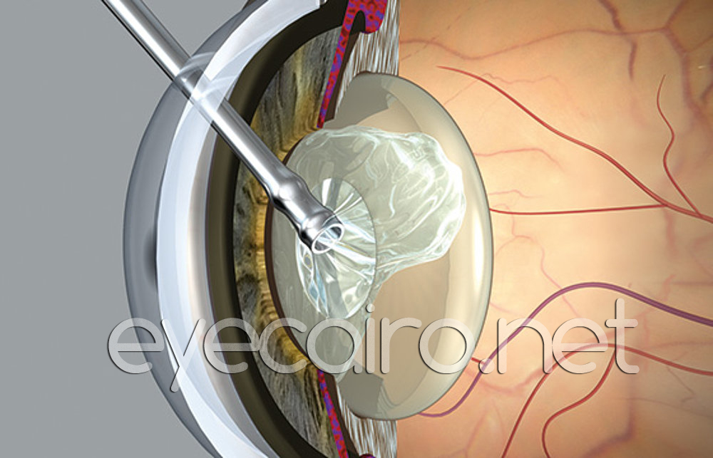 cataract-removal-t