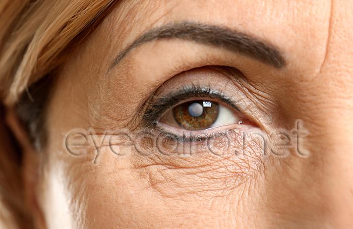 cataract-s-t-700x454