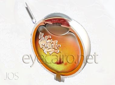 intravitreal-injection-lucentis4t-379x280