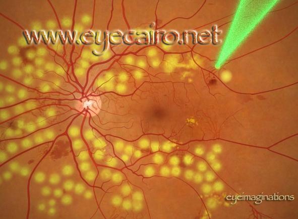 laser-treatment-retina-591x436