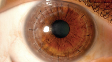 corneal-grafting-st