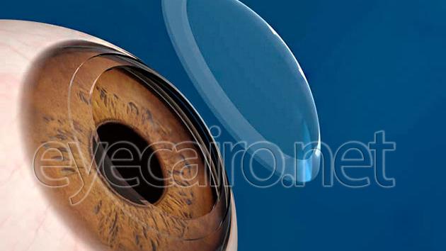 keratoplasty-t-630x354