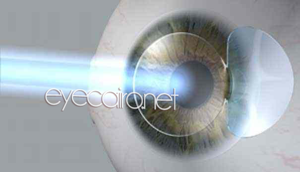 lasik_vision-correction-eyecairo