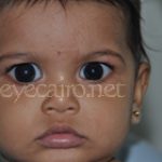 congenital-glaucoma-mona-yemen-ll